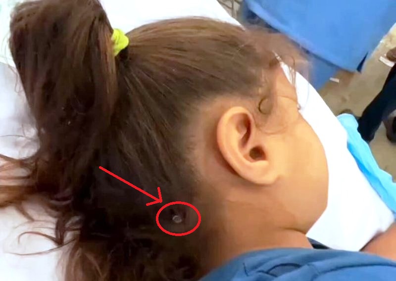 Bullet Pierces Child’s Head, She Miraculously Survives