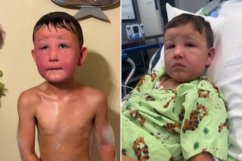 Dozens of Children Left with Head Injuries after Massive Hail Hits During Recess as Storm Batters Switzerland and Italy